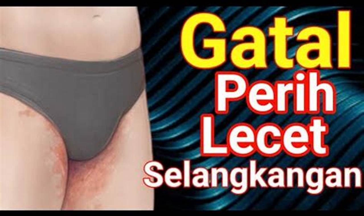 Cara Mengatasi Selangkangan Lecet